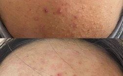 acne.org祛痘效果到底怎么样？