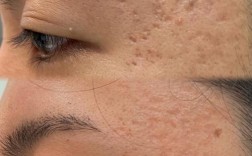 微针祛痘怎么反而留痘坑了？