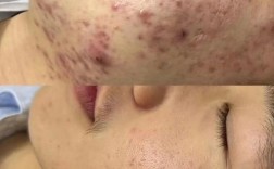 激光祛痘印效果最好的方法是什么？