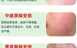 护肤品脸刺痛是过敏还是刺激？