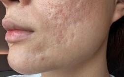 痘印、痘疤、痘坑，如何有效祛除？