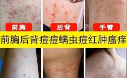 红霉素软膏能治背部痘痘吗？