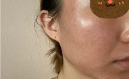 自体血清PRP祛痘印效果怎么样？