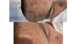 男士油痘肌如何兼顾祛痘与美白？