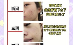 普通方法祛痘，哪种最有效？