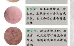 祛痘前必须先挤痘吗？