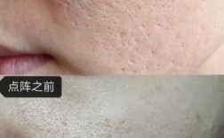 激光祛痘坑后多久能恢复如初？