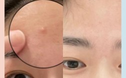 狮王祛痘膏后能直接化妆吗？