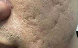 瓷肌祛痘后为何还长痘？