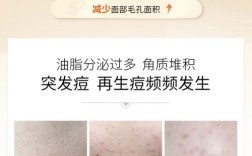 祛痘化妆品真的能去痘吗？
