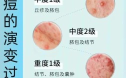 长痘脸能不能去角质？