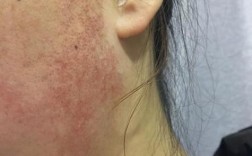 护肤品用完两颊刺痛是过敏了吗？