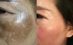 中药祛痘祛斑会反弹不