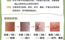 瓷肌祛痘为何还长痘？