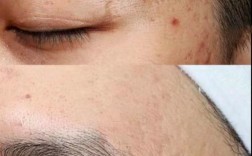 激光祛斑祛痘疤真的有效吗？