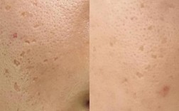 激光祛痘后为何会色素沉着？