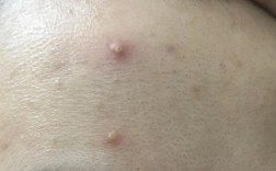 男士油痘肌如何快速消脓包？