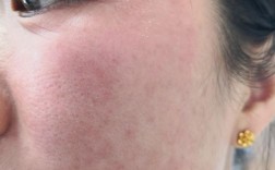 护肤品过敏症状有哪些？