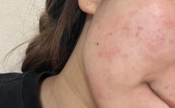 换护肤品后脸红，是过敏还是不适应？