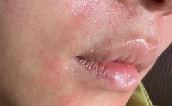 护肤品擦脸刺痛怎么办？