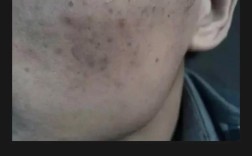 痘印黑色怎么快速祛除？