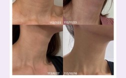 脂肪填充后护肤品怎么选？