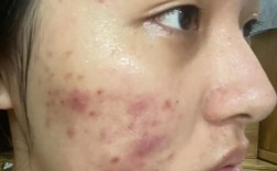 果汁小铺天然护肤为何会烂脸？