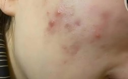 护肤营养过剩会长痘吗？