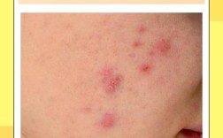 祛痘印痘疤最有效果的