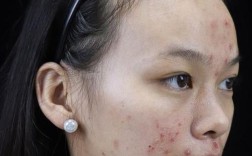 激光祛痘后多久才能正常洗脸？