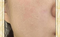 护肤品用后脸干皮咋回事？