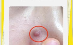 鼻梁长痘怎么快速祛除？