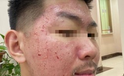 北京激光祛痘印效果好吗？