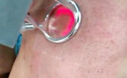 激光祛痘有哪些副作用？