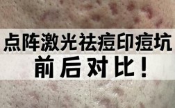 祛痘坑激光种类怎么选？