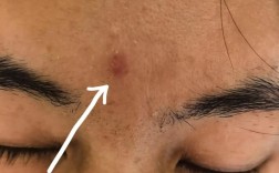 激光祛痘后悔？是坑还是没选对？