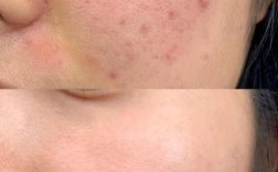 精油祛痘印真的有效吗？