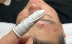 秘方祛痘药水怎么保存