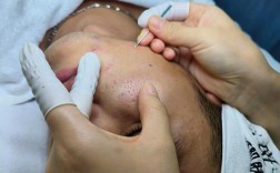 做了OPT红蓝光祛痘