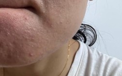 护肤品用后起小米粒疙瘩是过敏吗？