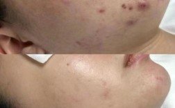 祛痘留痘印？美容院有风险吗？