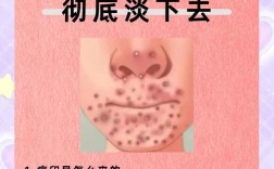 祛痘印最有效方法是什么？