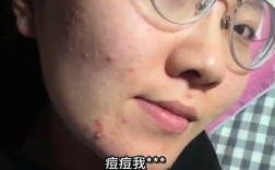 喝中药祛痘会先出痘多吗