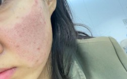 激光祛痘过程到底有多可怕？