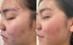 活动面部肌肉真能祛痘吗？