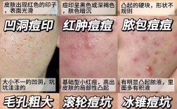 祛痘和痘印最有效的方法究竟是什么？