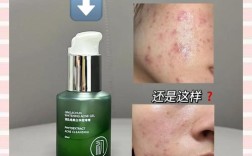 破皮后能用祛痘精油吗？