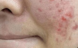 祛痘后痘印多久能消失？