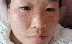 成都彩光祛黄褐斑祛痘