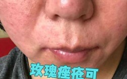 酒精擦脸祛痘真的安全有效吗？